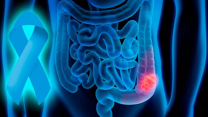 Março Azul em João Pessoa Destaca Colonoscopia como Aliada Contra o Câncer Colorretal