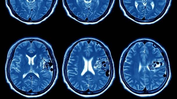 Avanço contra Câncer de Cabeça e Pescoço com Imunoterapia